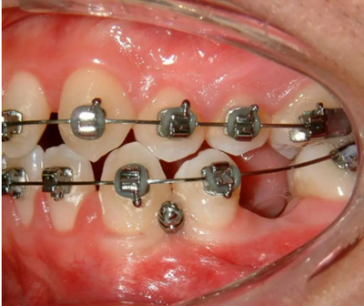 孩子必须换完牙才开始整牙吗？关于儿童正畸你应该知道这些……