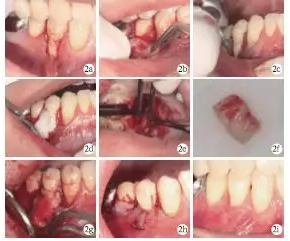 侧向转位瓣结合上皮下结缔组织移植治疗重度MillerⅢ°牙龈退缩1例
