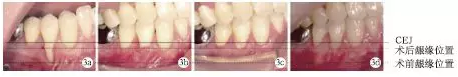 侧向转位瓣结合上皮下结缔组织移植治疗重度MillerⅢ°牙龈退缩1例