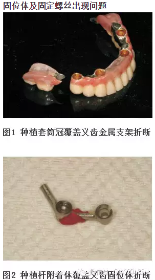 【经验分享】无牙颌种植修复固位的并发症与处理——宋应亮教授