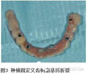 【经验分享】无牙颌种植修复固位的并发症与处理——宋应亮教授