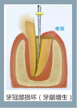 多频技术的根管长度测定仪