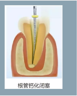 多频技术的根管长度测定仪