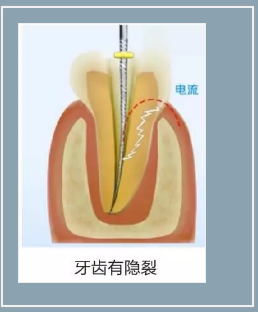 多频技术的根管长度测定仪