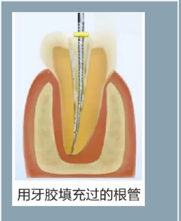 多频技术的根管长度测定仪