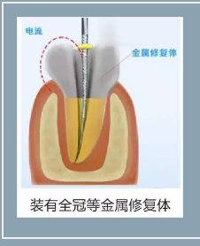 多频技术的根管长度测定仪