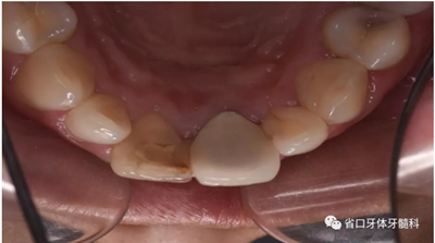 上前牙根管再治疗后内漂白1例