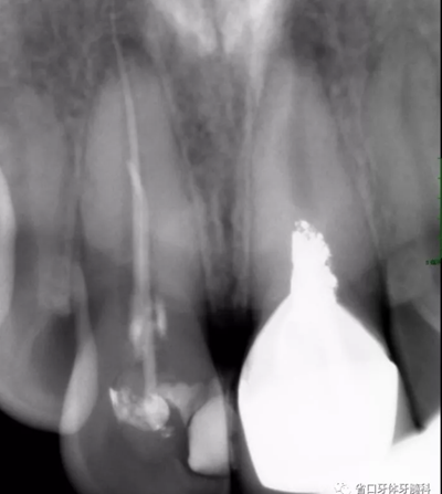 上前牙根管再治疗后内漂白1例