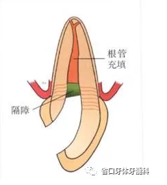 上前牙根管再治疗后内漂白1例