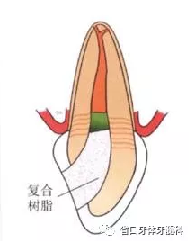 上前牙根管再治疗后内漂白1例