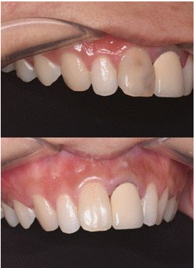 上前牙根管再治疗后内漂白1例