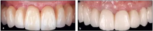 【文献精读】唇-齿-牙槽嵴分类：无牙颌上颌牙弓指南。诊断，风险评估及种植治疗指征
