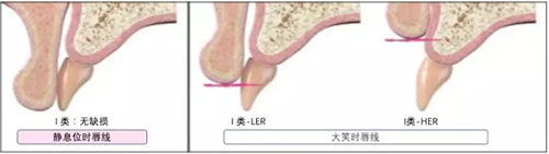 【文献精读】唇-齿-牙槽嵴分类：无牙颌上颌牙弓指南。诊断，风险评估及种植治疗指征