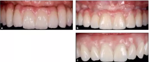 【文献精读】唇-齿-牙槽嵴分类：无牙颌上颌牙弓指南。诊断，风险评估及种植治疗指征