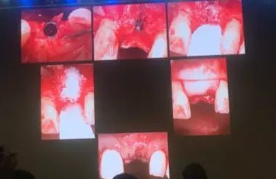 【听课笔记】拔牙后位点的软硬组织处理