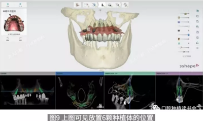 病例报道│全程数字化辅助无牙颌种植即刻负重