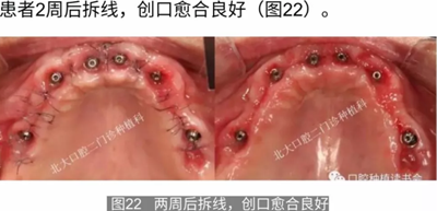 病例报道│全程数字化辅助无牙颌种植即刻负重