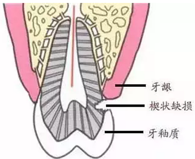 今天开始不要再这样刷牙了，你的牙齿快被刷掉了！