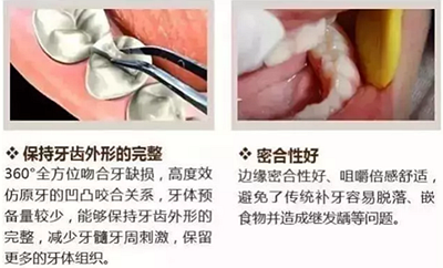 嵌体，比补牙更好的选择！细听7大优势！