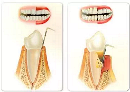 上海嘉福口腔研究所二十一世纪牙周病的临床进展