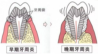 上海嘉福口腔研究所二十一世纪牙周病的临床进展