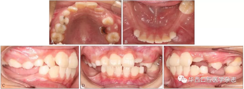 右下颌第一磨牙远中水平阻生1例