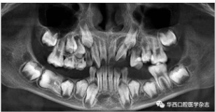 右下颌第一磨牙远中水平阻生1例