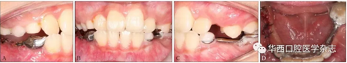 右下颌第一磨牙远中水平阻生1例