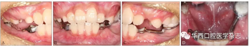 右下颌第一磨牙远中水平阻生1例