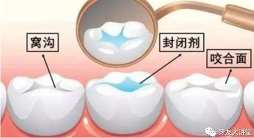 窝沟封闭剂