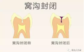 窝沟封闭剂