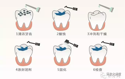 窝沟封闭剂