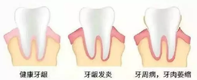 牙周炎，中国成年人后半生永远的 痛 ！