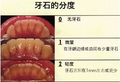 牙周炎，中国成年人后半生永远的 痛 ！