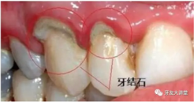 牙周炎，中国成年人后半生永远的 痛 ！