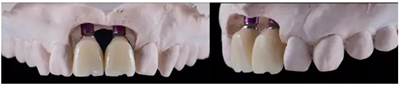 Asc全瓷角度基台一体冠进行种植前牙美学修复一例