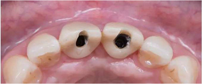 Asc全瓷角度基台一体冠进行种植前牙美学修复一例
