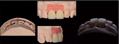 Asc全瓷角度基台一体冠进行种植前牙美学修复一例