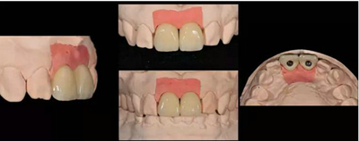Asc全瓷角度基台一体冠进行种植前牙美学修复一例