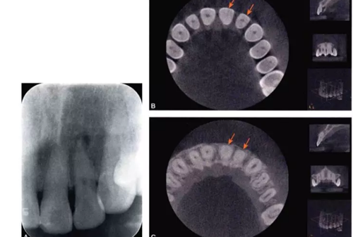 （六期）细小钙化根管的疏通——病因及诊断
