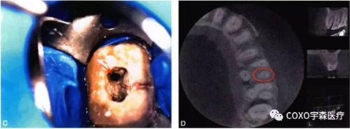 （六期）细小钙化根管的疏通——病因及诊断