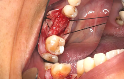 病例分享|下颌后牙牙槽嵴保存延期种植颊侧骨壁吸收植骨引导骨再生一例