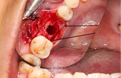 病例分享|下颌后牙牙槽嵴保存延期种植颊侧骨壁吸收植骨引导骨再生一例