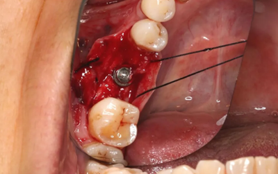 病例分享|下颌后牙牙槽嵴保存延期种植颊侧骨壁吸收植骨引导骨再生一例