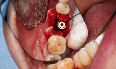 病例分享|下颌后牙牙槽嵴保存延期种植颊侧骨壁吸收植骨引导骨再生一例
