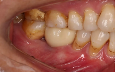 病例分享|下颌后牙牙槽嵴保存延期种植颊侧骨壁吸收植骨引导骨再生一例