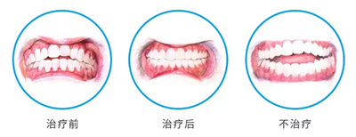 儿童早期矫治问题