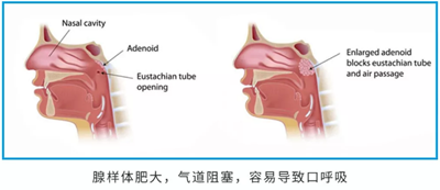 儿童早期矫治问题