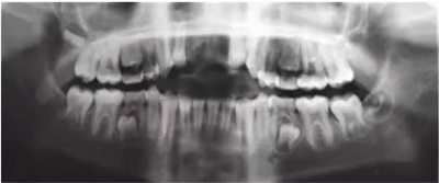 【病例分享】上颌中切牙区外伤的自体移植和正畸治疗