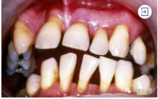 怎样预防牙龈萎缩